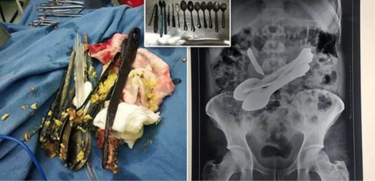 Doctors Remove Knife, 8 Spoons, Screwdrivers, Toothbrushes From Man's Stomach