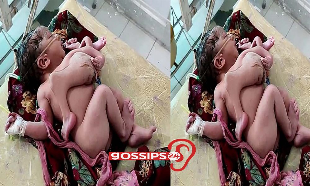 Baby girl born with four legs and three hands